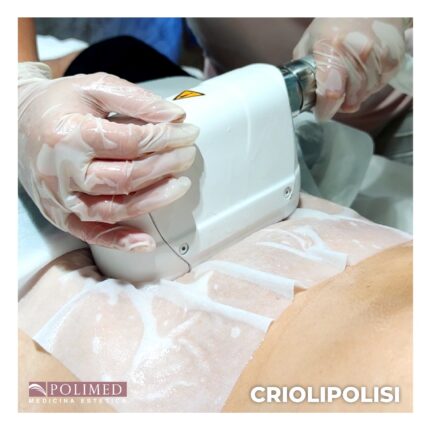 CRIOLIPOLISI